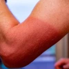 a person's subburned arm